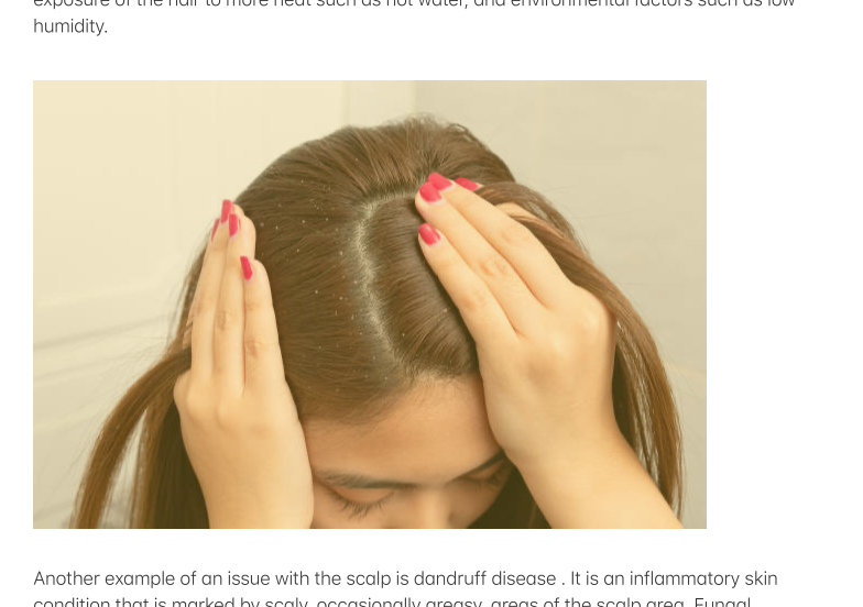 Rid of Itchy Scalp